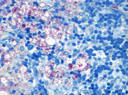 Mycobacterium leprae staining or leprosy with wade fite